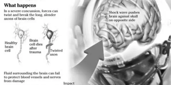 Chronic Brain Damage Exaggerated In NFL Players