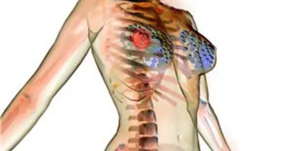 How Hormone Replacement Therapy And The Pill Can Lead To Breast Cancer