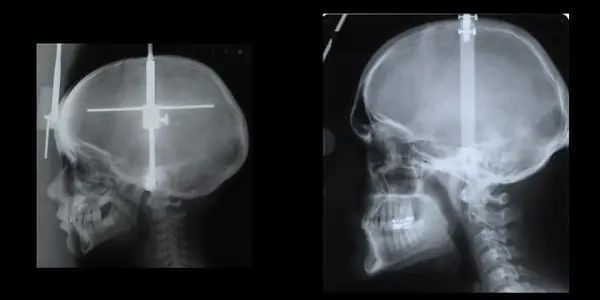 Neanderthals Didn't Have Them - So Why Did Human Chins Evolve?