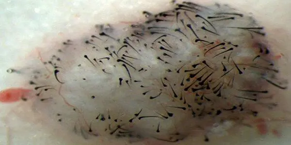 Adult Stem Cells Used To Grow New Hair