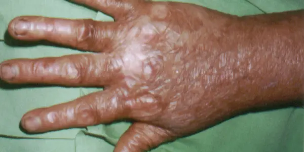 Kindler Syndrome