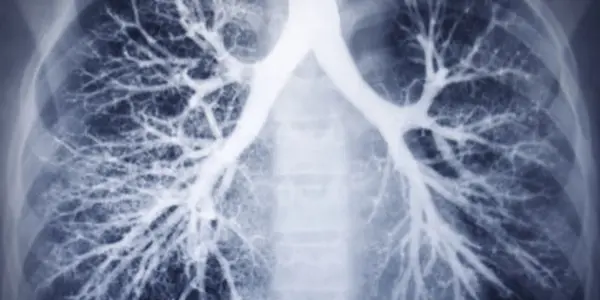 Fixing 'leaky' Blood Vessels To Combat Severe Respiratory Ailments