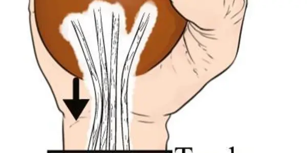Mechanized Human Hands Improve Function Lost To Nerve Damage
