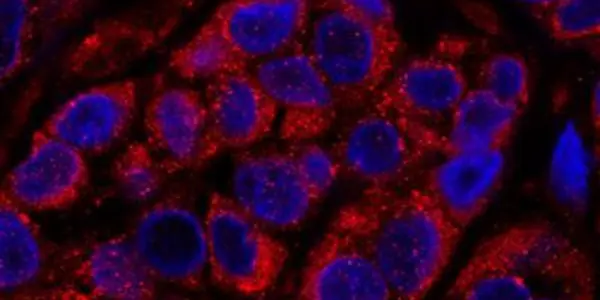 More Than 40 Melanoma-specific Genes That Determine Aggressiveness Discovered