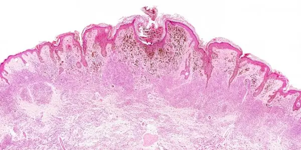 Melanoma: Why Lymph Nodes Matter In How Cancer Cells Spread
