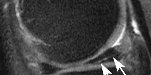 Meniscal Surgery: Common Knee Procedure May Lead To Arthritis And Cartilage Loss