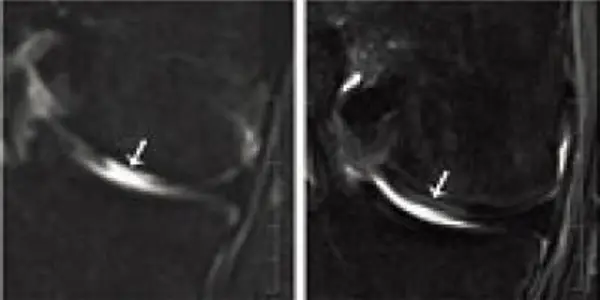 Nasal Septum Cells: From Nose To Knee, Engineered Cartilage Regenerates Joints