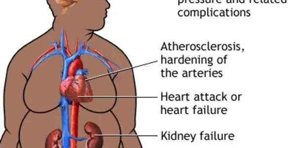 Going Under the Knife to Treat Diabetes