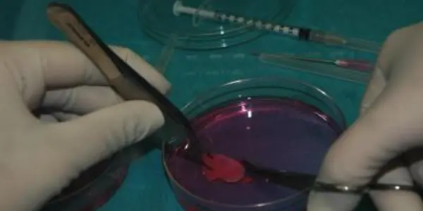 First Child Born To Woman Using Ovarian Tissue Frozen During Her Childhood