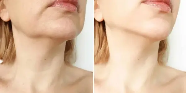 Move Over Ozempic. FDA Has Approved A New Weight Loss Injection Celebrities Will Exploit