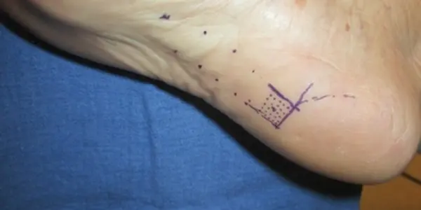 A Cure For Plantar Fasciitis May Be Fat Injections