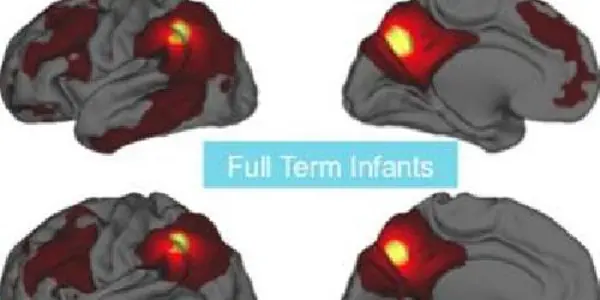 Premature Birth Linked To Weaker Brain Connections