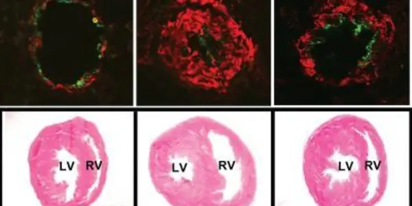 Oxidized Lipids: Protein In HDL May Be Key To Treating Pulmonary Hypertension