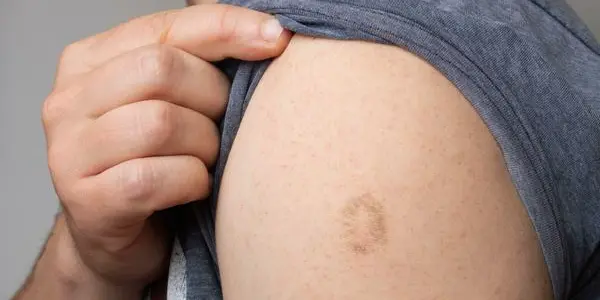 Monkeypox: Most Infected Won't Need Them But We Already Have Vaccines And Drugs For It