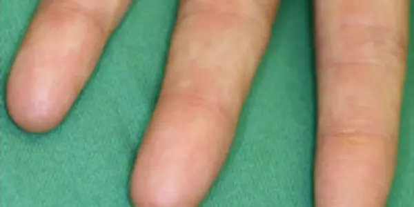 Mutation Erases Fingerprints