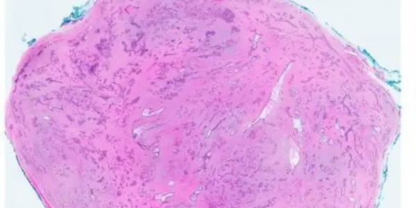 A Genetic Cause Of Common Breast Tumors