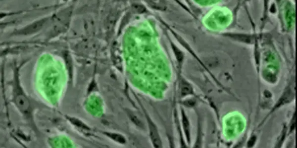 First Human Stem Cell Clinical Trial - Why It Matters