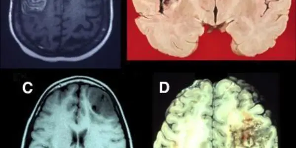 Studying Prefrontal Lobe Damage Unlocks Brain Mysteries