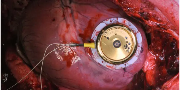 Battery-Less Pacemaker Works Like An Automatic Wristwatch - Powered By Heart Motion