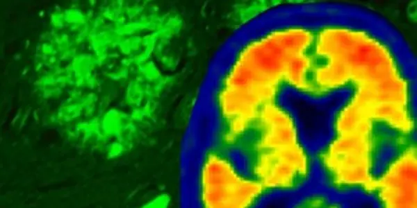 Alzheimer's: Tau, Not Amyloid, Is The Primary Driver