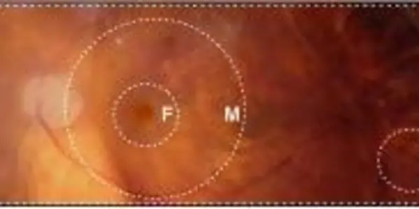 A Molecular Map For Eye Disease