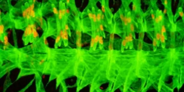 Cachexia Is The Real Cause Of Death In One Third Of Patients With Cancer - Study