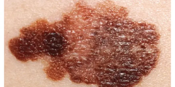 Melanoma: 4 Things To Know