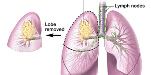Radioactive 'Seeds' May Lead To Better Lung Cancer Prognosis