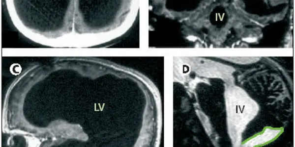 The Mystery Of The Man With The Tiny Brain