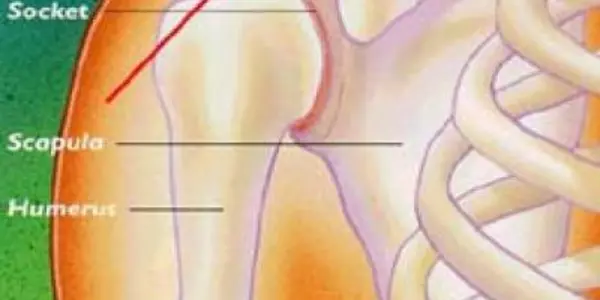 Healing a shoulder separation