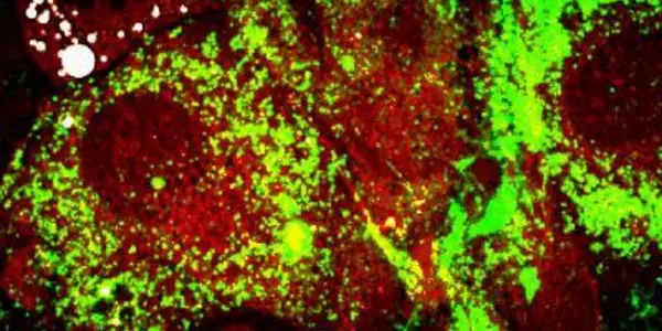 Findings show insulin -- not genes -- linked to obesity