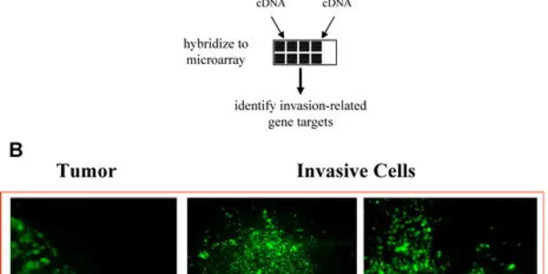 Invasion Of The Brain Tumors