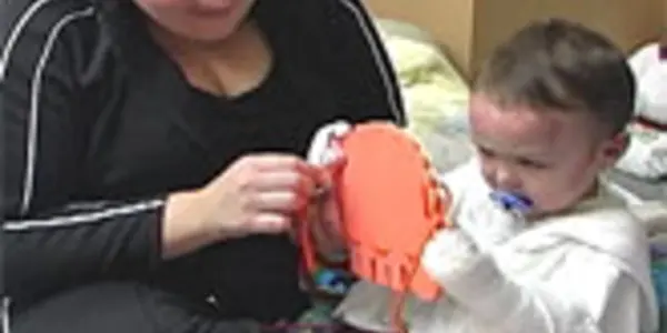 First Systemic Therapy For Fatal RDEB Childhood Disease