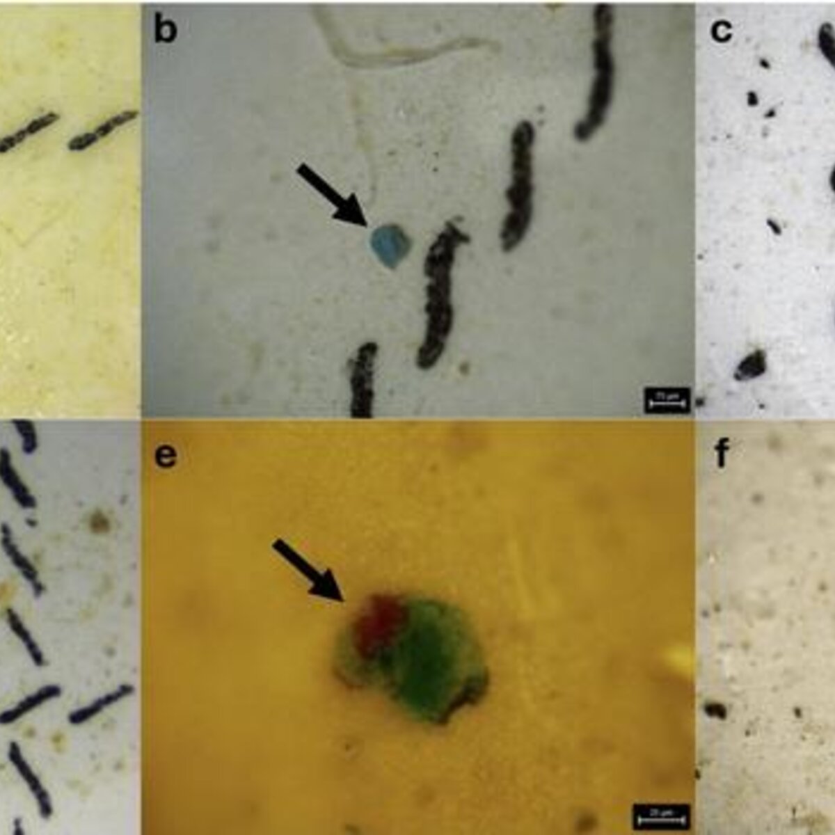 Epidemiology: Microplastics Cause Lung Cancer
