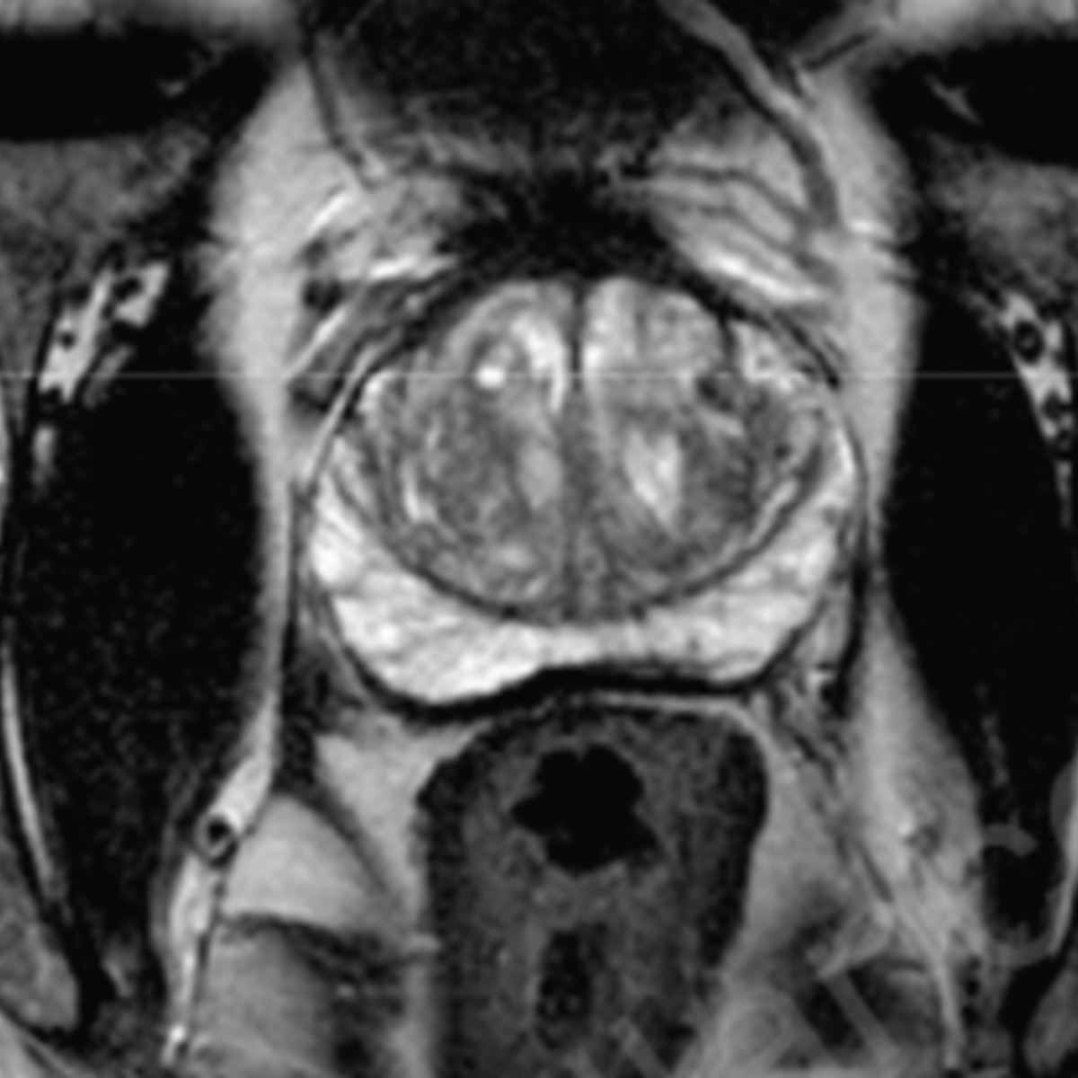 Major Increase In MRI Before Prostate Biopsy - Is It Necessary?