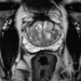 Major Increase In MRI Before Prostate Biopsy - Is It Necessary?